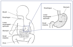 When the lower esophageal  sphincter has poor closure, stomach content can regurgitate back up into the esophagus.  